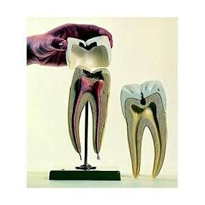  SOMSO® Molar With Caries Model: Industrial & Scientific